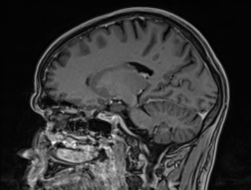 Cerebral venous thrombosis (Radiopaedia 71207-81504 Sagittal T1 C+ 24).jpg