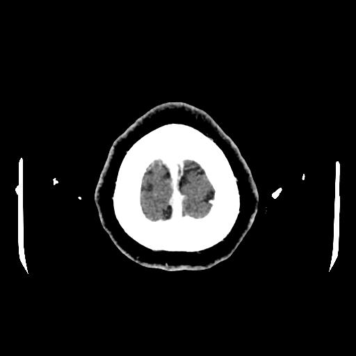 Cerebral venous thrombosis with venous hemorrhagic infarct (Radiopaedia 90354-107660 Axial with contrast 161).jpg