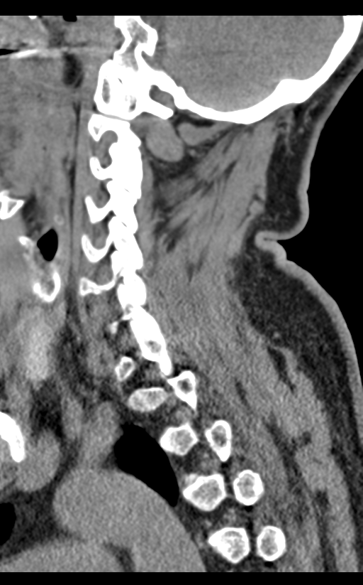 Cervical canal stenosis - OPLL and osteophytes (Radiopaedia 47329-51910 B 26).png