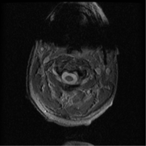 Cervical canal stenosis with cord compression (Radiopaedia 34114-35374 Axial Gradient Echo 82).png