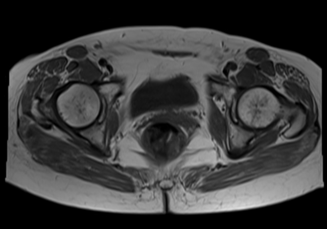 File:Cervical carcinoma (Radiopaedia 88312-104943 Axial T1 16).jpg