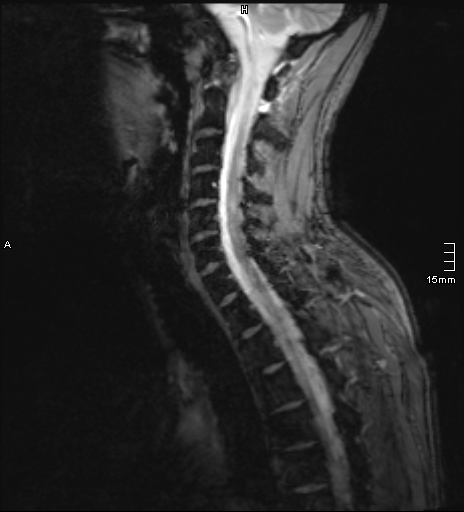 File:Cervical dural CSF leak on MRI and CT treated by blood patch (Radiopaedia 49748-54995 D 4).png