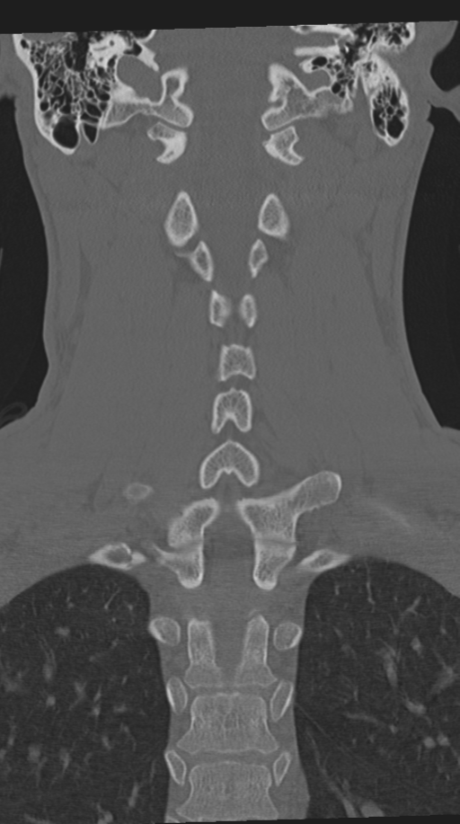 Cervical intercalary bone (Radiopaedia 35211-36748 Coronal bone window 48).png