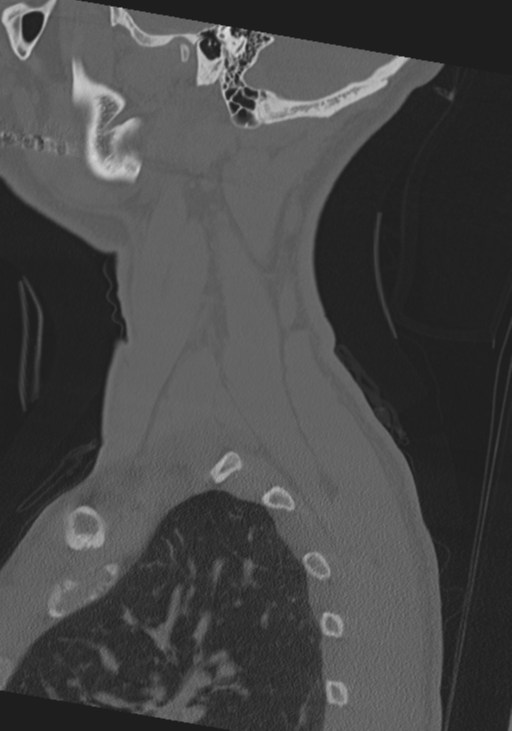 Cervical intercalary bone (Radiopaedia 35211-36748 Sagittal bone window 73).png