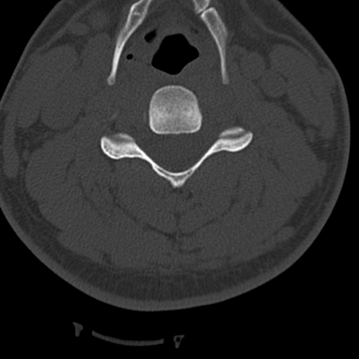 Cervical schwannoma (Radiopaedia 57979-64974 Axial bone window 25).png