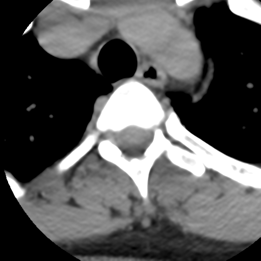 Cervical schwannoma (Radiopaedia 57979-64974 Axial non-contrast 71).png