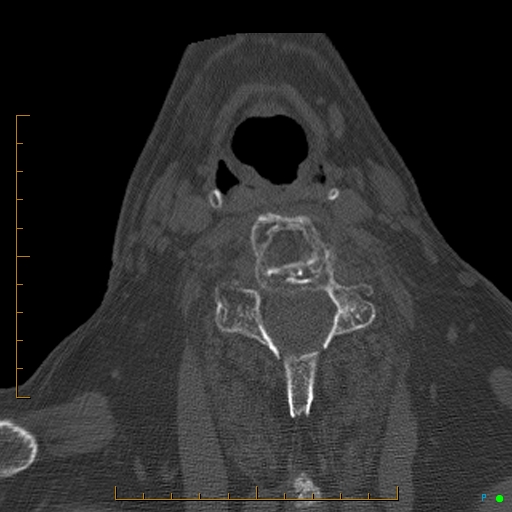 File:Cervical spine fracture - ankylosing spondylitis (Radiopaedia 76835-88706 Axial bone window 143).jpg