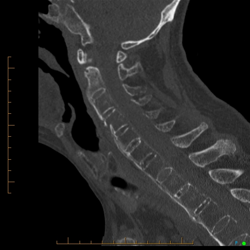Cervical spine fracture - ankylosing spondylitis (Radiopaedia 76835-88706 Sagittal bone window 54).jpg