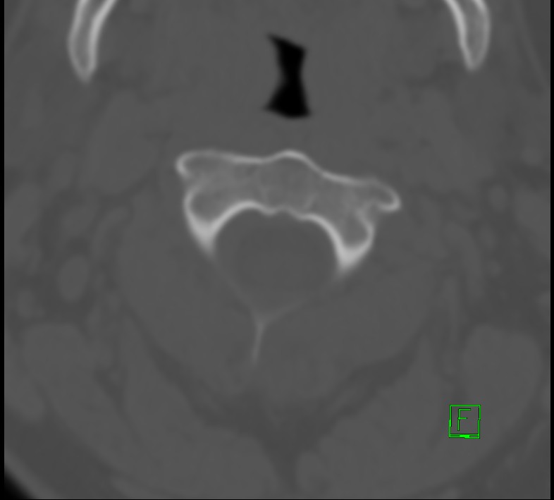 Cervical spine fracture - hyperflexion injury (Radiopaedia 66184-75364 Axial bone window 6).jpg