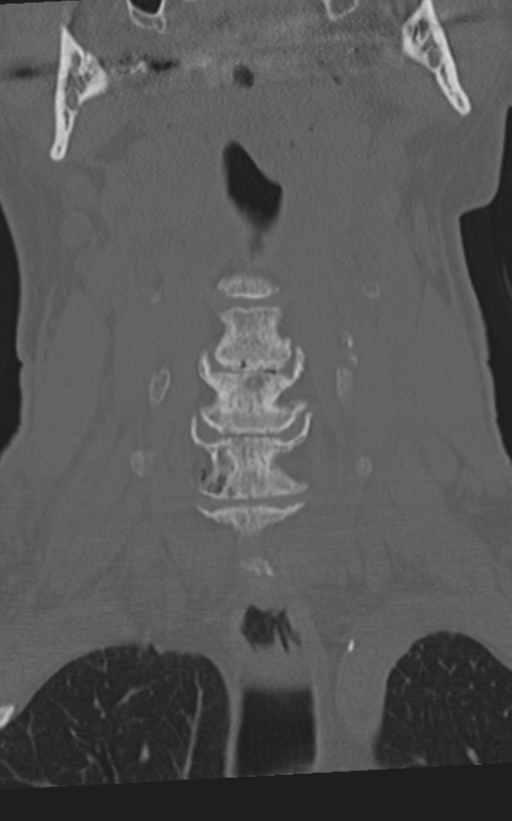 Cervical spine fractures with vertebral artery dissection (Radiopaedia 53296-59268 Coronal bone window 18).png