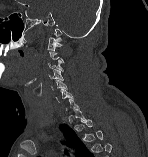 Cervical spine trauma with tear drop fracture and perched facet joint (Radiopaedia 53989-60127 Sagittal bone window 30).jpg