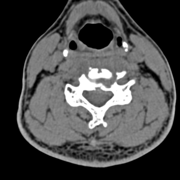 Cervical spondylodiscitis (Radiopaedia 28057-29489 Axial non-contrast 44).jpg