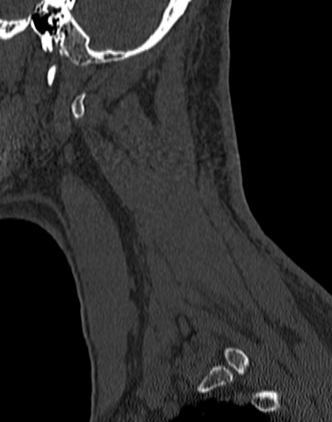 File:Cervical spondylodiscitis (Radiopaedia 28057-29489 Sagittal bone window 55).jpg