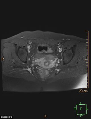 File:Cesarian scar endometriosis (Radiopaedia 68495-78066 Axial T1 C+ fat sat 16).jpg