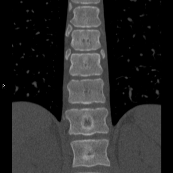 Chance fracture (Radiopaedia 36521-38081 Coronal bone window 29).jpg