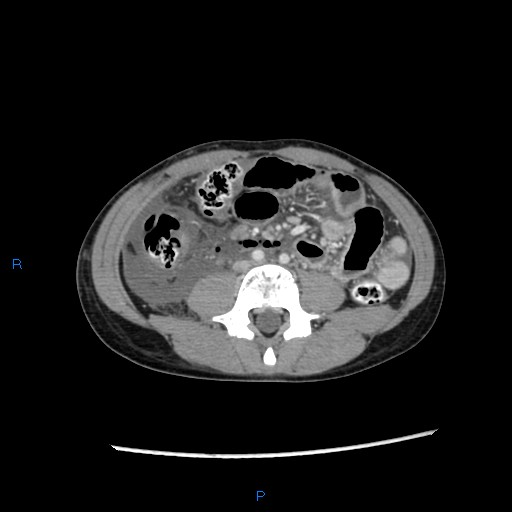 File:Chance fracture with duodenal and pancreatic lacerations (Radiopaedia 43477-46864 A 28).jpg