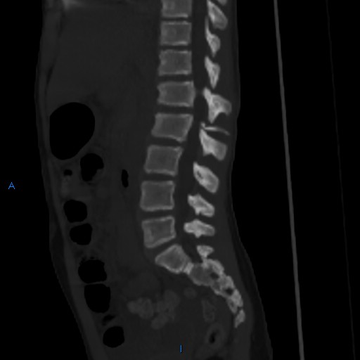 File:Chance fracture with duodenal and pancreatic lacerations (Radiopaedia 43477-50042 Sagittal bone window 11).jpg