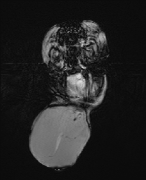 Chiari III malformation with occipital encephalocele (Radiopaedia 79446-92559 Axial SWI 22).jpg