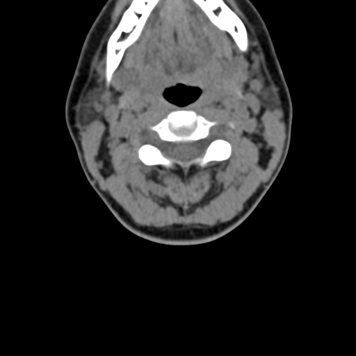 Chiari I malformation and obstructive hydrocephalus (Radiopaedia 41185-43981 D 44).png