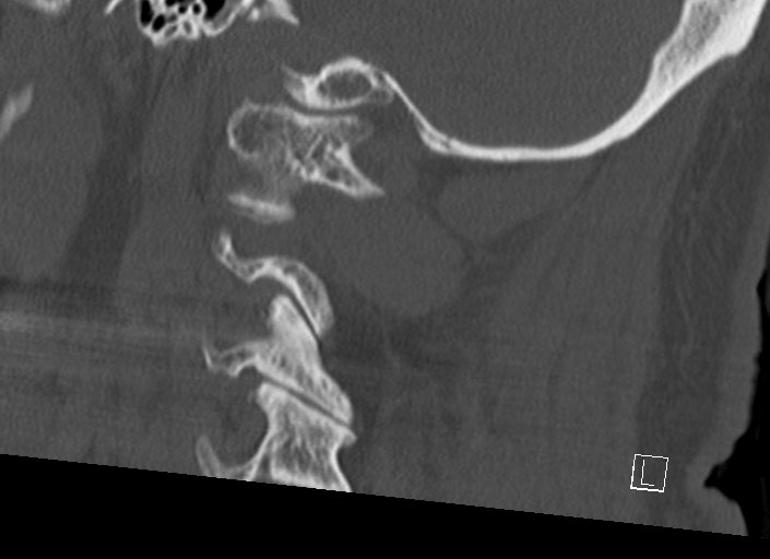 Chiari I malformation with a symptomatic syrinx of the posterolateral medulla oblongata (Radiopaedia 42573-45707 A 18).jpg