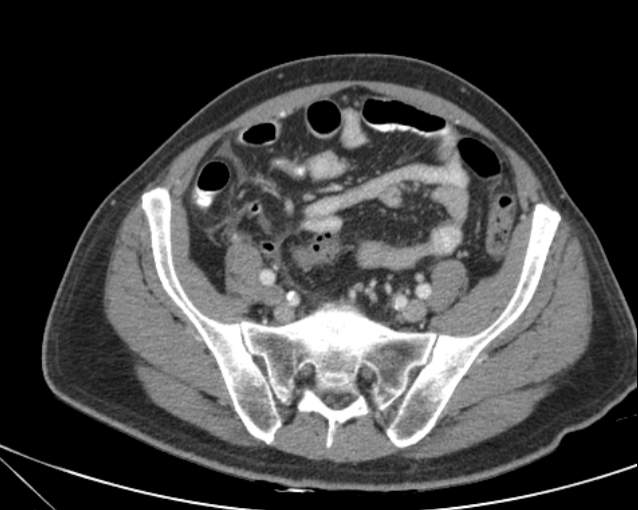 Cholecystitis - perforated gallbladder (Radiopaedia 57038-63916 A 63).jpg