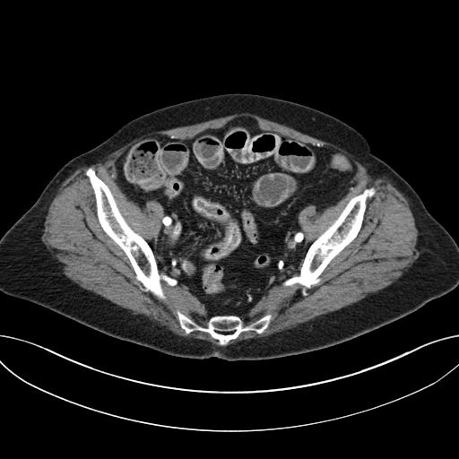 Cholecystoduodenal fistula due to calculous cholecystitis with gallstone migration (Radiopaedia 86875-103077 A 59).jpg