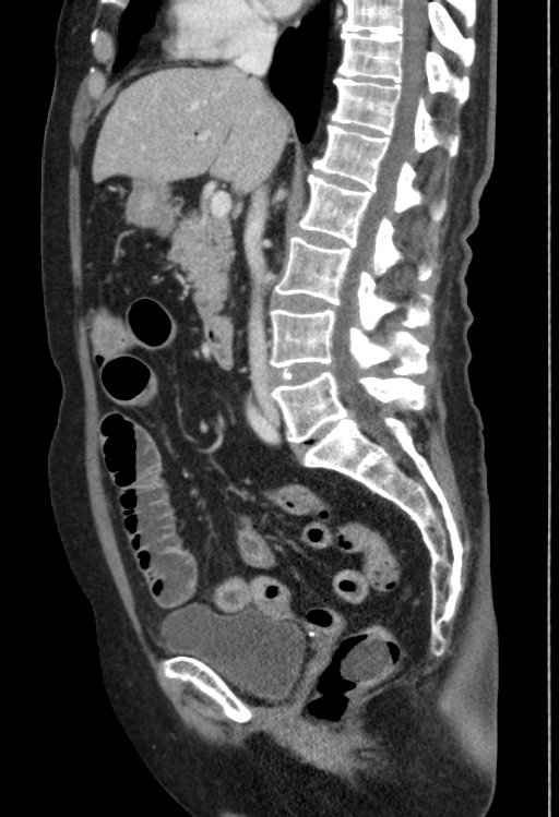 Cholecystoduodenal fistula due to calculous cholecystitis with gallstone migration (Radiopaedia 86875-103077 F 32).jpg