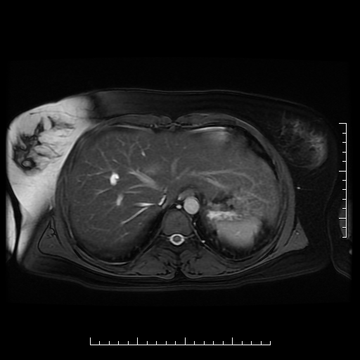 File:Choledochal cyst with chronic calcific pancreatitis (Radiopaedia 18245-18062 Axial T2 1).png
