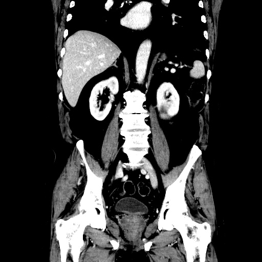 Choledocholiathiasis with normal caliber common bile duct (Radiopaedia 75368-86632 Coronal liver window 78).jpg