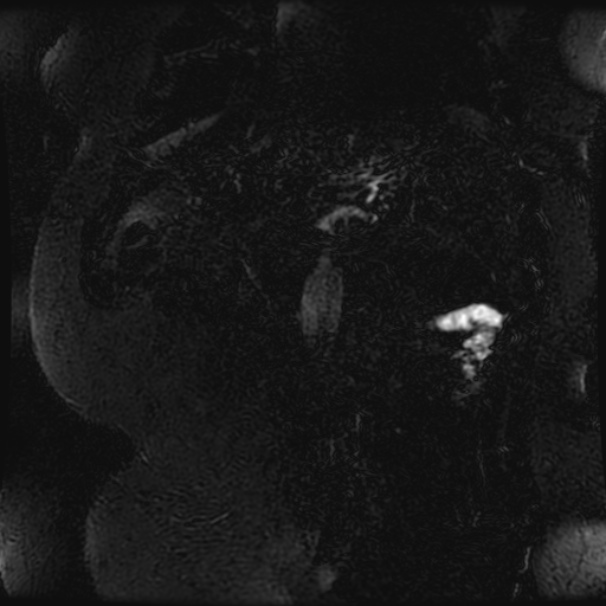 Choledocholithiasis on CT and MRI (Radiopaedia 24825-25088 Coronal T2 106).jpg