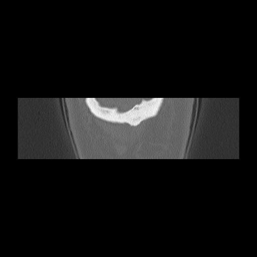 Cholesteatoma (Radiopaedia 84946-100455 Coronal bone window 167).jpg
