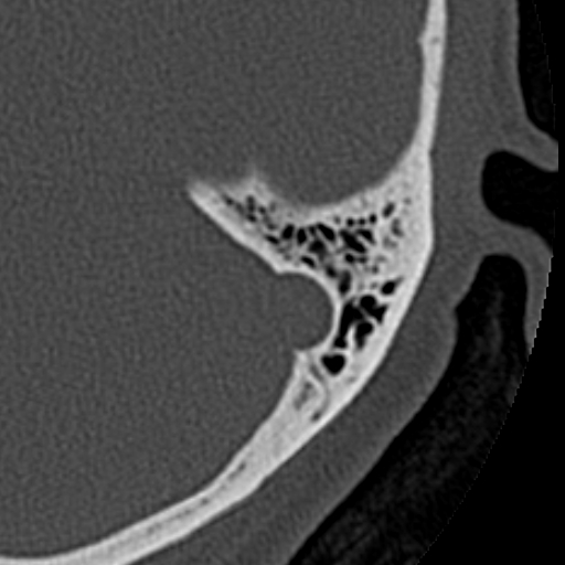 File:Cholesteatoma of the external ear (Radiopaedia 16540-16225 Axial bone window 8).jpg