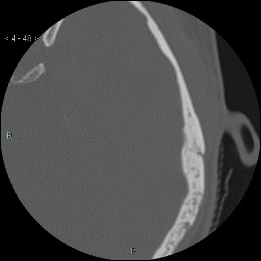 File:Cholesterol granuloma of the petrous apex (Radiopaedia 64358-73141 Axial bone window 24).jpg