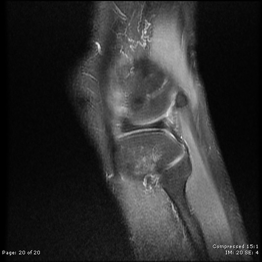 File:Chondroblastoma (Radiopaedia 25725-25891 Sagittal PD 20).jpg