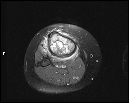 File:Chondroblastoma (Radiopaedia 62721-71031 Axial PD fat sat 28).jpg