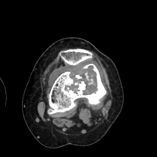 Chondrosarcoma - femur (Radiopaedia 64187-72954 Axial non-contrast 41).jpg