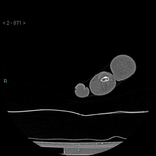 Chondrosarcoma - phalanx (Radiopaedia 69047-78812 Axial bone window 125).jpg