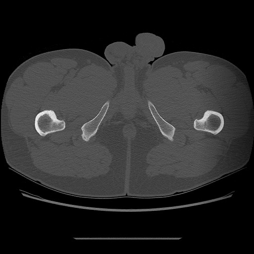 File:Chondrosarcoma of iliac wing (Radiopaedia 63861-72599 Axial bone window 136).jpg