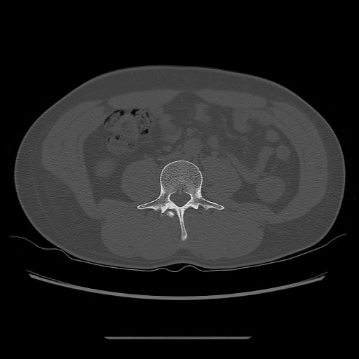 File:Chondrosarcoma of iliac wing (Radiopaedia 63861-72599 Axial bone window 7).jpg