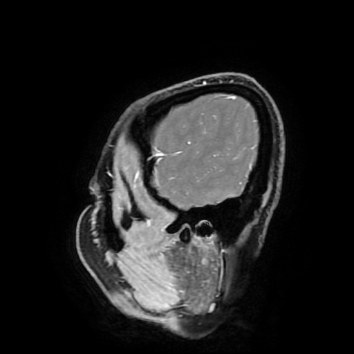 Chordoid glioma of third ventricle (Radiopaedia 91612-109340 F 35).jpg