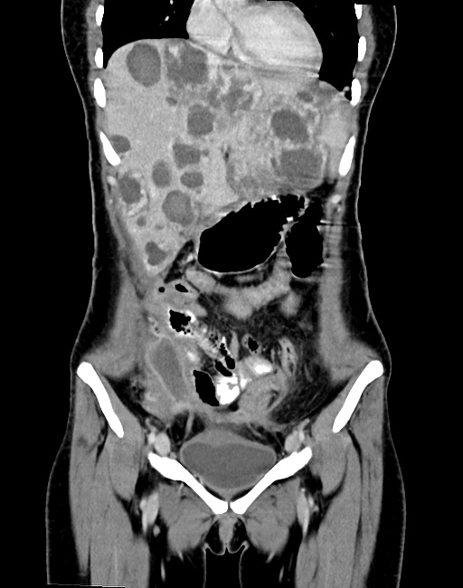 Choriocarcinoma liver metastases (Radiopaedia 74768-85766 B 36).jpg