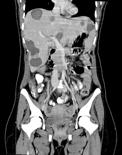 Choriocarcinoma liver metastases (Radiopaedia 74768-85766 B 50).jpg
