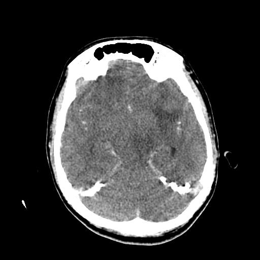 File:Choriocarcinoma of ovary with cerebral and pulmonary metastases (Radiopaedia 25983-26118 C+ arterial phase 64).jpg