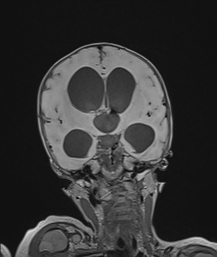 Choroid plexus papilloma (Radiopaedia 84612-100019 Coronal FLAIR 60).jpg