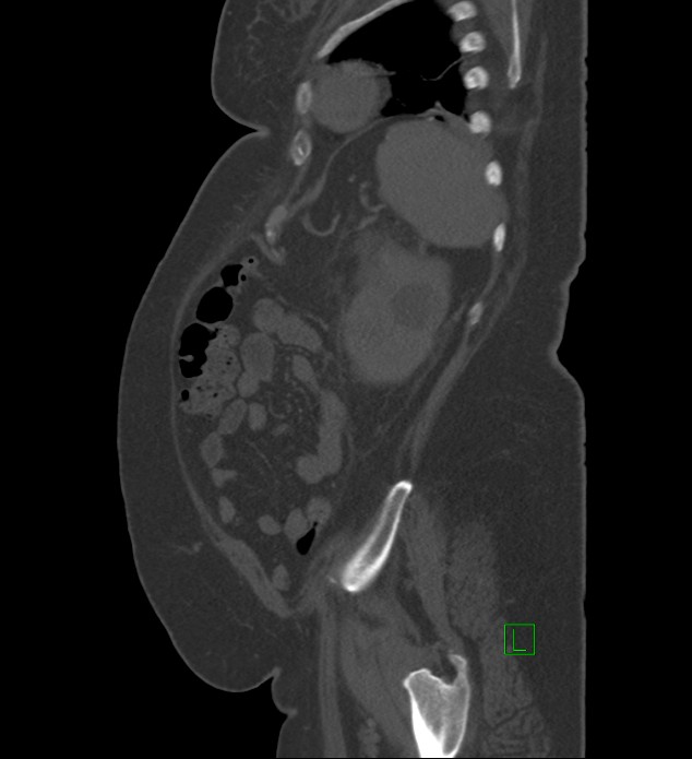 Chromophobe renal cell carcinoma (Radiopaedia 84239-99519 Sagittal bone window 19).jpg