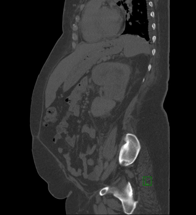 Chromophobe renal cell carcinoma (Radiopaedia 84239-99519 Sagittal bone window 37).jpg