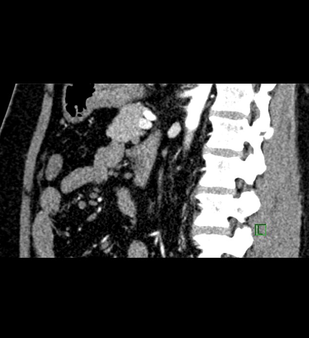 Chromophobe renal cell carcinoma (Radiopaedia 84286-99573 F 73).jpg