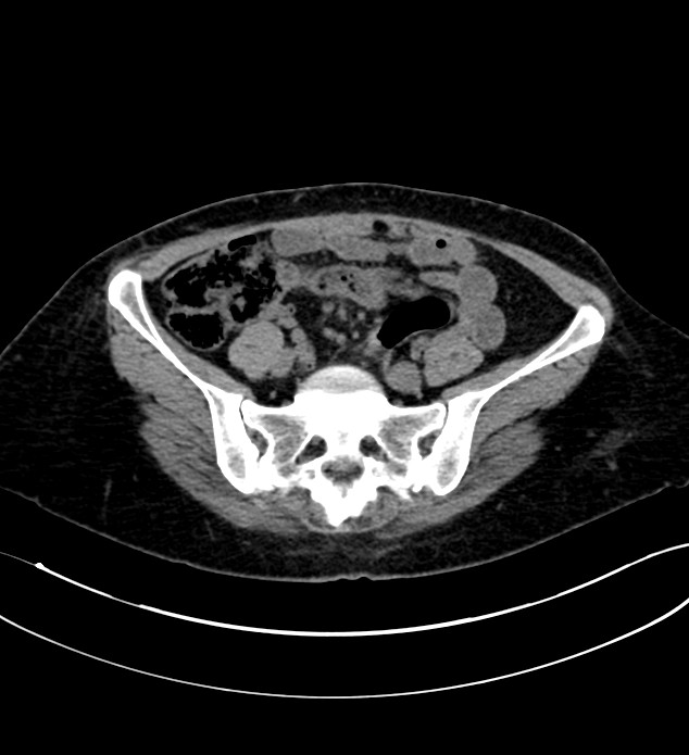 Chromophobe renal cell carcinoma (Radiopaedia 84290-99582 Axial non-contrast 108).jpg