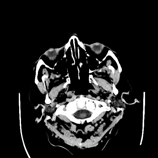 Chronic bilateral subdural hygroma (Radiopaedia 85801-101622 Axial non-contrast 21).jpg