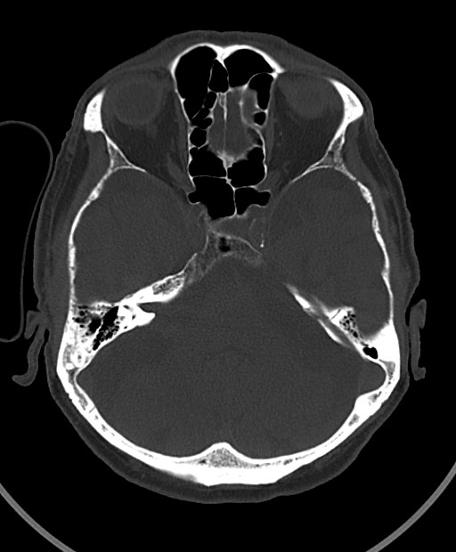 Chronic bilateral subdural hygroma (Radiopaedia 85801-101623 Axial bone window 88).jpg